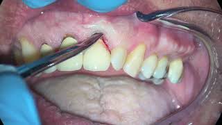 Anterior Incisor Extraction Due to Persistent Apical Periodontitis [upl. by Geirk565]