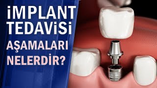 İmplant tedavisi aşamaları nelerdir [upl. by Innavoj]