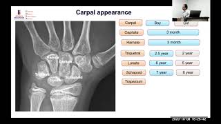 Practical Bone Age Assessment [upl. by Natale]