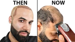 I Shaved My HEAD BALD 4 Years After Hair Transplant  Surgeon Reacts [upl. by Ecenahs]