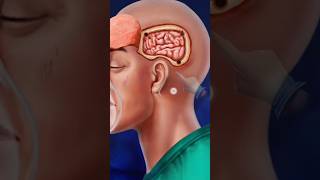 Craniotomy and cranioplasty Animation Asmr [upl. by Nalac]