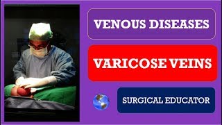 Varicose Vein Symptoms and Signs [upl. by Norm496]