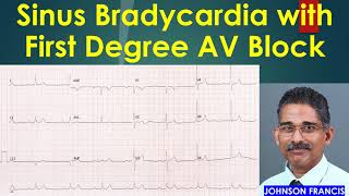 Sinus Bradycardia with First Degree AV Block [upl. by Hastie]