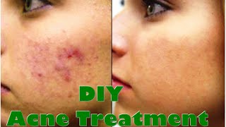 DIY Acne Treatment  It Works How to Get Rid of Acne [upl. by Jenkins83]