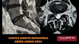 14112024  IL L5S1  SÍNDROME DO RECESSO LATERAL POR HÉRNIA DISCAL  VÍDEO 4K [upl. by Bradlee]