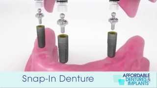 Demo How Do SnapIn Dentures With Implants Work [upl. by Batory]