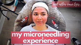 MICRONEEDLING PROCEDURE  aftercare tips skin updates before and after [upl. by Nara437]