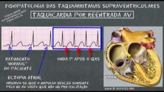 Taquicardias supraventriculares [upl. by Leur]