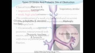 inspiratory Stridor [upl. by Silecara]