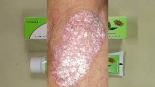 REVIEW Sorion Natural Moisturizing Cream  Psoriasis Skin Care with Coconut Oil and Neem [upl. by Hsak801]