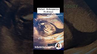 Fetal echogenic kidneys  Dr Surbhi Gupta Aggarwal  Consultant Radiologist [upl. by Husain]