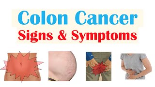 Colon Cancer CRC Signs amp Symptoms amp Why They Occur [upl. by Odradlig]