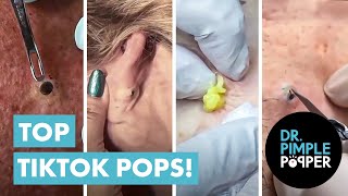 Dr Pimple Popper’s Top 10 Tiktok Pops [upl. by Anailil]