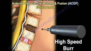 Cervical Spine Decompression And Fusion   Everything You Need To Know  Dr Nabil Ebraheim [upl. by Nivalc501]