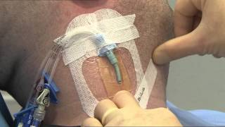 3M™ Tegaderm™ CHG IV Dressing 1657R Application and Removal Video CVC [upl. by Petulia756]