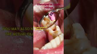 Dislodged or Loose Fillings dentist filling [upl. by Ettenej]