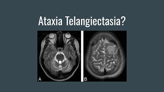 What is Ataxia Telangiectasia AT [upl. by Navetse]