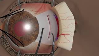 Strabismus surgery Recession [upl. by Roi]