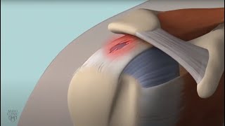 Learn About Rotator Cuff Damage [upl. by Eeslehc]