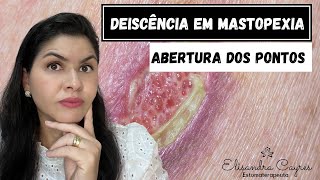 DEISCÊNCIA EM MASTOPEXIA  ESTOMATERAPIA [upl. by Luapnaej458]