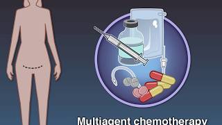 Lymphadenectomy and Survival in Ovarian Cancer [upl. by Nathanael]