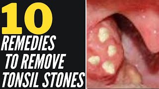 Tonsil Stone Popping 2021  What are Tonsil Stones [upl. by Philis]