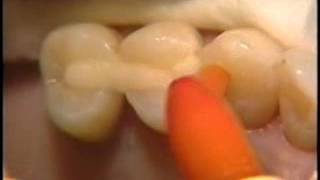 Posterior Periodontal Splint [upl. by Byrn]