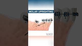 MOLAR UPRIGHTING  ORTHODONTIC TIPS Shorts [upl. by Reppep]