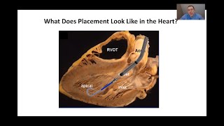 Echocardiographic Assessment of Impella Placement [upl. by Niela]