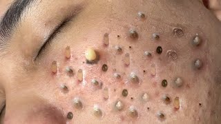 ACNE TREATMENT VU QUYNH MI Blackheads Removal Popping [upl. by Gilda270]