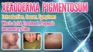 Xeroderma pigmentosum causes symptoms treatment prognosis documentary pronunciation  XP [upl. by Whetstone]