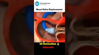 Heart Valve Replacement Procedure 👨‍⚕️ [upl. by Ahsiekar]