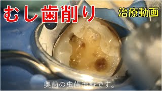 むし歯削り。虫歯治療の動画Dental Caries [upl. by Etnuad]