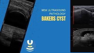 Bakers cyst demonstrated on ultrasound [upl. by Lachus]