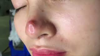 Big infected Acne removal on nose ZOOMX2 [upl. by Eilsek]