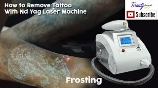 How to Remove Tattoo With Nd Yag Laser Machine  Beauty Channel IND [upl. by Yllom]