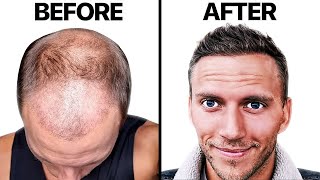 AWFUL Hair Transplant 4 Month RECOVERY  Hair Surgeon Reacts [upl. by Ahsitniuq]