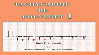 ECG Interpretation tres facile de l ECG 11eme partie TSV Tachycardie Jonctionnelle 1 [upl. by Orabla]