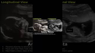 Anterior Placenta Position Ultrasound  Fetal USG  Pregnancy Sonography  Dr Sams Imaging shorts [upl. by Celina]