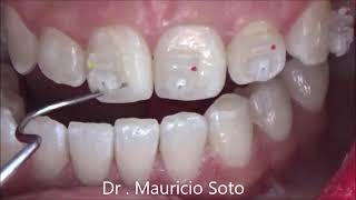 Orthodontic Brackets Bonding step by step [upl. by Buehler]