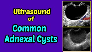 Ultrasound of Common Adnexal Cysts [upl. by Yllop61]