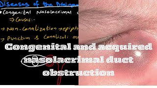 Congenital and acquired nasolacrimal duct obstruction  CNLO  ANLO [upl. by Alegnaoj]