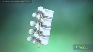 Spinal fractures Definition [upl. by Ignaz]