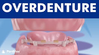 Overdenture with dental implants © [upl. by Hajan]