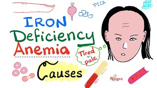 Iron Deficiency Anemia  Causes  Hematology Series [upl. by Greene497]