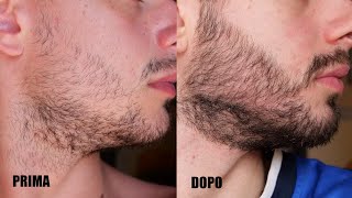 Come far crescere la barba in 4 mesi  Minoxidil [upl. by Balliol220]