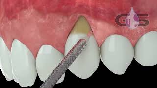 PeriAcryl® 3D Demonstration [upl. by Packston]