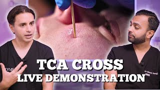 TCA Cross For Acne Live Demonstration  TCA Cross Aftercare Advice  Dr Somji amp Solomon Discuss [upl. by Corrina]