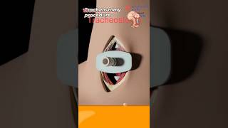 What is tracheostomy procedure 🧐 sorts [upl. by Lertnom762]