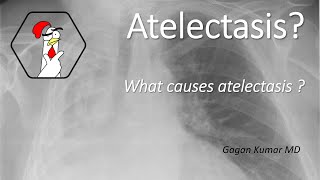 Atelectasis  part 1  What causes atelectasis [upl. by Stulin]